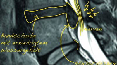 Permalink zu:Bandscheibenvorfall und mehr