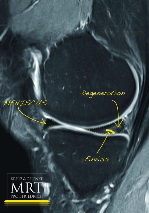 meniscal-tear_homepage